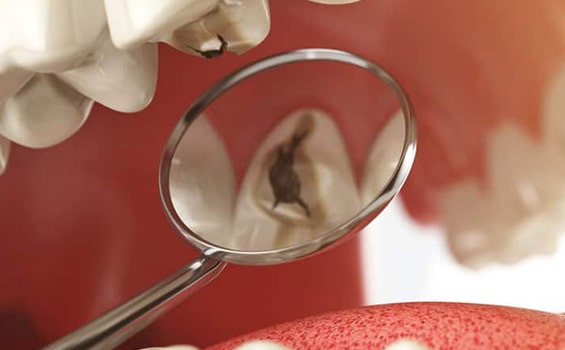 Root Canal Treatment